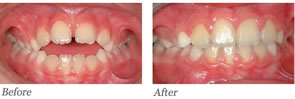 This patient is age nine. He had no digital habit but a large open bite. A limited number of braces were used. 