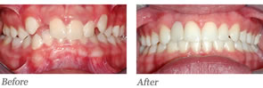 This patient had a missing lateral incisor. Braces were used to open space for future crown to be placed by the general dentist.