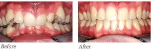 This patient had a deep overbite and crowding. Treatment involved full braces for 48 months including jaw surgery to move his lower jaw forward.